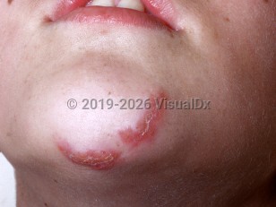 Clinical image of Berylliosis - imageId=1031671. Click to open in gallery.  caption: 'Curvilinear scaly and crusted erythematous plaques on the chin.'