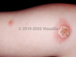 Clinical image of Accidental implantation vaccinia - imageId=1036991. Click to open in gallery.  caption: 'A crusted, cloudy bulla with a scalloped border and surrounding erythema, with a nearby vesicle atop an erythematous macule, on the upper arm.'