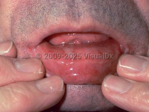 Clinical image of Mucous membrane pemphigoid - imageId=109411. Click to open in gallery.  caption: 'Erosions on the labial mucosa.'