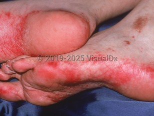 Clinical image of Acral erythema - imageId=1101276. Click to open in gallery.  caption: 'Brightly erythematous patches on the soles and lateral foot secondary to doxorubicin.'
