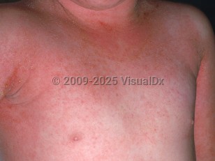 Erythroderma