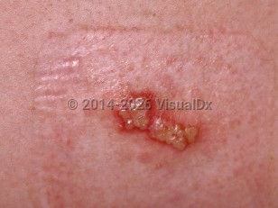 Herpes simplex virus