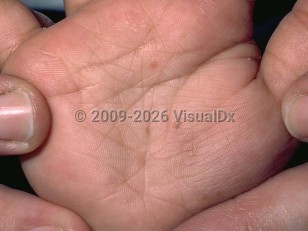 Clinical image of Acropustulosis of infancy - imageId=112054. Click to open in gallery.  caption: 'Scant thin crusts and light brown macules on the palm.'