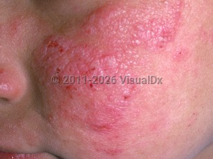 Clinical image of Actinic prurigo - imageId=1125822. Click to open in gallery.  caption: 'Scaly and crusted pink papules and plaques on the cheek.'
