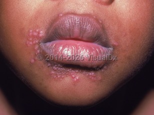 Clinical image of Periorificial dermatitis of childhood - imageId=1172467. Click to open in gallery.  caption: 'Numerous substantive pink papules around the mouth.'