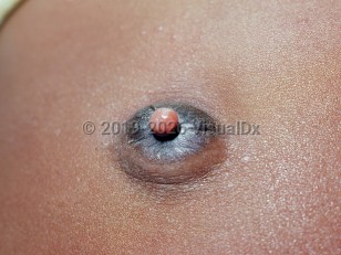 Clinical image of Umbilical polyp - imageId=1244480. Click to open in gallery.  caption: 'A moist, pedunculated, light red papule arising from an everted umbilicus.'