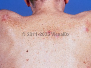 Clinical image of Chronic lymphocytic leukemia - imageId=1267391. Click to open in gallery.  caption: 'Pink and whitish papules and plaques on the upper back.'