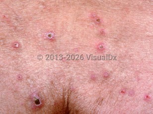 Reactive perforating collagenosis