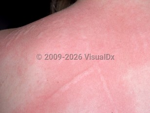 Clinical image of Dermographism - imageId=1308870. Click to open in gallery.  caption: 'Linear pink, edematous plaques with surrounding pink erythema on the back, with similar papules (hives) in the vicinity.'