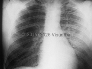 Pneumonic plague
