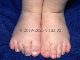 Clinical image of Nager syndrome - imageId=1337665. Click to open in gallery.  caption: 'Partial syndactyly and clinodactyly of the toes.'