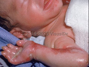Clinical image of Generalized severe epidermolysis bullosa simplex - imageId=1354140. Click to open in gallery.  caption: 'Sheets of desquamation and large crusted erosions on the arm with some vesicles on the chin.'