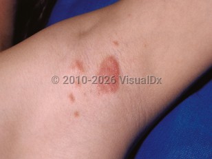 Inverse psoriasis
