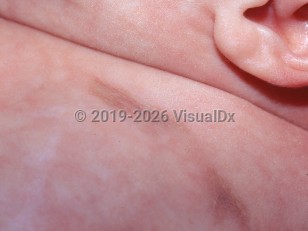 Clinical image of Anetoderma of prematurity - imageId=1421923. Click to open in gallery.  caption: 'Atrophic light brown-gray plaques on the chest.'
