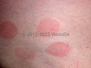 Clinical image of Allergic contact dermatitis - imageId=1446. Click to open in gallery.  caption: 'A close-up of round and oval, pink plaques with scant scale.'