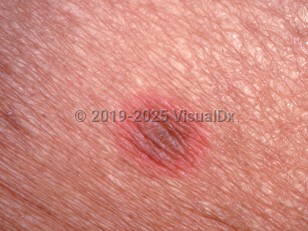 Clinical image of Fixed drug eruption - imageId=1453376. Click to open in gallery.  caption: 'A close-up of a round bright red plaque with a central darker color.'