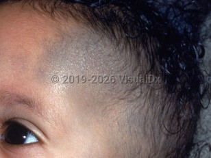 Clinical image of Nevus of Ota - imageId=1469618. Click to open in gallery.  caption: 'A large dark gray patch on the forehead and temple, extending into the scalp.'
