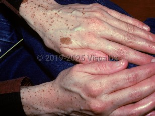 Clinical image of Multiple lentigines syndrome - imageId=1470876. Click to open in gallery.  caption: 'Myriads of brown macules on the hands.'