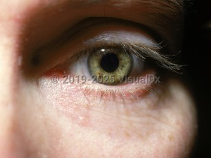 Clinical image of Iris freckle - imageId=1471309. Click to open in gallery.  caption: 'Tiny brown macules on the iris.'