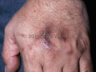 Drug-induced pigmentation