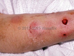 Clinical image of Skin bacterial abscess - imageId=154367. Click to open in gallery.  caption: 'Abscesses on the forearm, one with an ulcer and crust.'
