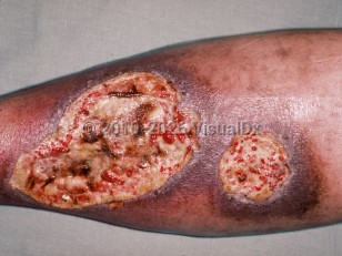 Antiphospholipid antibody syndrome