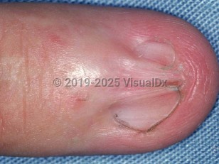 Clinical image of Nail pterygium - imageId=1661066. Click to open in gallery.  caption: 'Dorsal pterygium of the fingernail. The proximal nail fold projection is fused with the underlying nail matrix, with division of the nail plate into 2 lateral wings.'