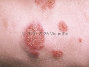 Cryptococcosis