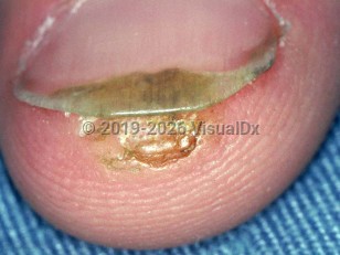 Clinical image of Subungual wart - imageId=1666494. Click to open in gallery.  caption: 'A crusted and verrucous papule at the fingertip, extending under the nail.'