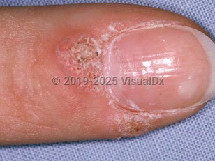 Clinical image of Periungual wart - imageId=1667003. Click to open in gallery.  caption: 'Verrucous papules at the proximal and lateral nailfold.'