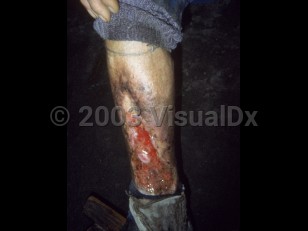 Clinical image of Glanders - imageId=1667527. Click to open in gallery.  caption: 'A deep ulcer with surrounding hyperpigmentation and scarring on the leg.'