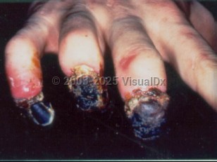 Clinical image of Septicemic plague - imageId=1670846. Click to open in gallery.  caption: 'Necrosis of the distal digits appearing as black, crusted plaques with loss of some of the fingernails.'