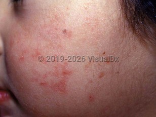 Clinical image of Congenital erythropoietic porphyria - imageId=1691868. Click to open in gallery.  caption: 'Tiny round crusts and erythematous macules and patches on the cheek.'
