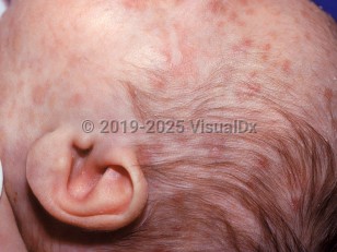 Clinical image of Acute myelomonocytic leukemia - imageId=1709060. Click to open in gallery.  caption: 'Widespread pink papules and plaques of varying thickness, on the face and scalp.'