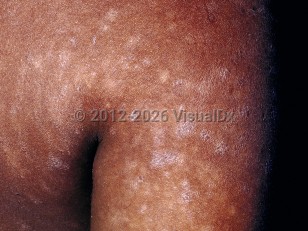 Pityriasis lichenoides chronica