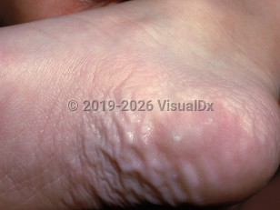 Clinical image of Calcified nodules of the heels - imageId=1730421. Click to open in gallery.  caption: 'A shiny papule on the heel.'