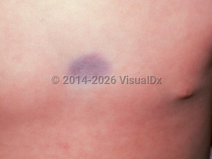 Clinical image of Cutaneous arteriovenous malformation - imageId=1735267. Click to open in gallery.  caption: 'A close-up of a violaceous plaque on the chest.'