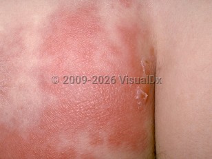 Clinical image of Erysipelas - imageId=175775. Click to open in gallery.  caption: 'A close-up of a deeply erythematous, edematous, and vesiculated patterned plaque on the buttock.'