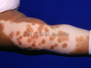 Clinical image of Piebaldism - imageId=1780154. Click to open in gallery.  caption: 'A large depigmented patch with blotches of preserved pigment, on the leg.'