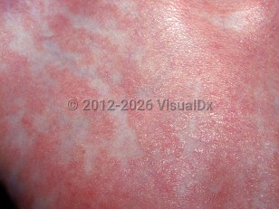 Clinical image of Juvenile pityriasis rubra pilaris - imageId=1787397. Click to open in gallery.  caption: 'A close-up of well-demarcated orange-pink plaques with fine scale.'