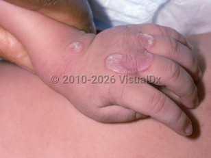 Clinical image of Vitamin A deficiency - imageId=1813257. Click to open in gallery.  caption: 'Patterned, keratotic pink plaques on the dorsal hand and wrist (phrynoderma).'