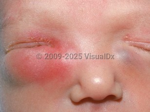 Clinical image of Neonatal dacryocystitis - imageId=1834943. Click to open in gallery.  caption: 'Marked infraorbital edema and erythema and milder similar supraorbital changes with overlying crusting on the right, and a smooth bluish papule on the left infraorbital skin.'