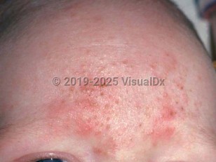 Clinical image of Eosinophilic pustular folliculitis in infancy - imageId=1836643. Click to open in gallery.  caption: 'Numerous tiny papules and crusts on the forehead.'