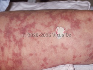 Disseminated intravascular coagulation