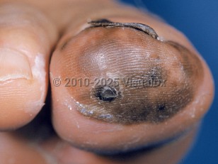 Clinical image of Acral lentiginous melanoma - imageId=1847552. Click to open in gallery.  caption: 'A variegated brown and black, asymmetric plaque on the distal toe with pigment in the toenail.'