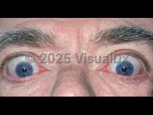 Graves ophthalmopathy