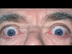 Graves ophthalmopathy