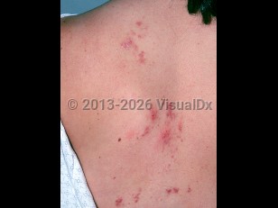 Schistosomiasis