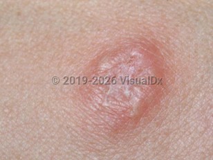 Brucellosis