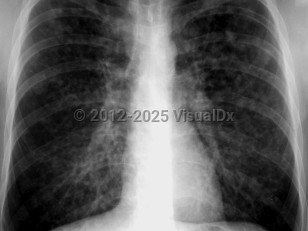 Varicella pneumonia